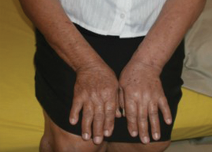 BTL-6000_Lymphastim_PIC_after_Sandra_Farina_hand