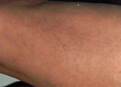 BTL-6000_Lymphastim_PIC_after_Sandra_Farina_leg