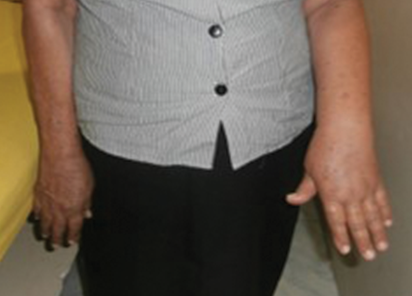 BTL-6000_Lymphastim_PIC_before_Sandra_Farina_hand