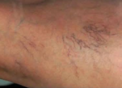 BTL-6000_Lymphastim_PIC_before_Sandra_Farina_leg