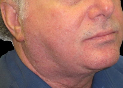 BTL_Exilis_System_PIC_022-After-eyes-male-William-Loverme-MD-3TX_412x296px