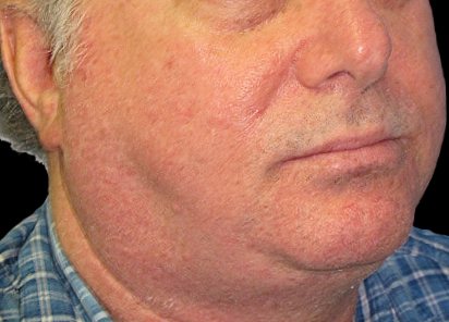 До процедур EXILIS