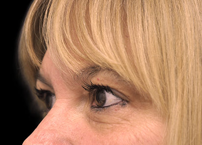 До процедур EXILIS