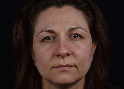 До процедуры на аппарате EMFUSION