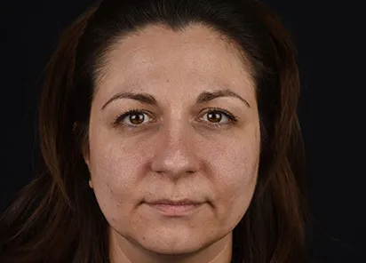 После процедуры на аппарате EMFUSION