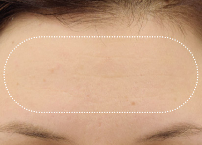 Emface_PIC_021-After-forehead-female-BTL-Aesthetics-3M_412x296px
