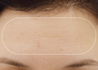 Emface_PIC_021-Before-forehead-female-BTL-Aesthetics_412x296px