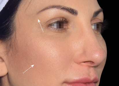 Emface_PIC_030-After-face-female-Yael-Halaas-MD-4TX_101_412x296px