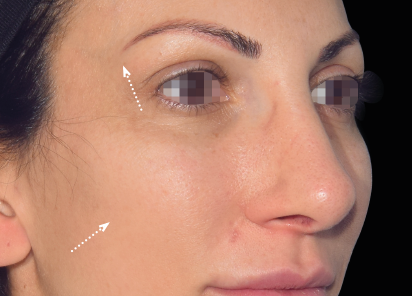 Emface_PIC_030-Before-face-female-Yael-Halaas-MD_101_412x296px