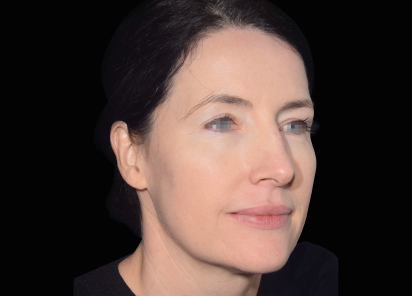 Emface_PIC_032-After-face-female-Yael-Halaas-MD-4TX_101_412x296px