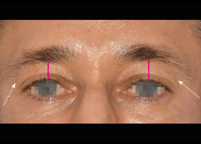 Emface_PIC_033-After-forehead-male-Yael-Halaas-MD-4TX_101_412x296px