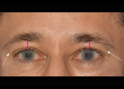 Emface_PIC_033-Before-forehead-male-Yael-Halaas-MD_101_412x296px