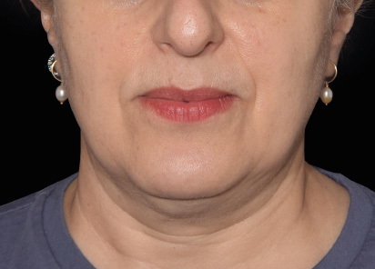 Emface_PIC_035-After-jawline-female-Yael-Halaas-MD-4TX_412x296px