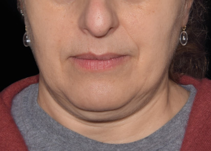 Emface_PIC_035-Before-jawline-female-Yael-Halaas-MD_412x296px