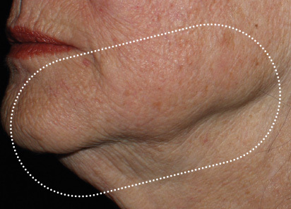 Emface_PIC_042-After-jawline-female-Richar-Gentile-MD-1M-AL_412x296px