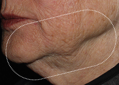 Emface_PIC_042-Before-jawline-female-Richar-Gentile-MD_412x296px