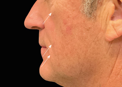 Emface_PIC_047-After-face-male-Charles-Boyd-MD-3M-4TX_412x296px