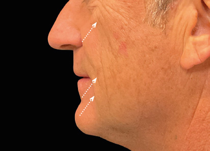 Emface_PIC_047-Before-face-male-Charles-Boyd-MD_412x296px