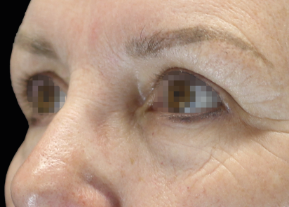 Emface_PIC_051-Before-eyes-female-Joel-L-Cohen-MD_101_412x296px