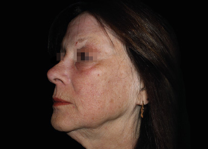 Emface_PIC_052-After-face-female-Richar-Gentile-MD-1M-AL_412x296px_1664798060_original_v2