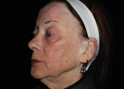 Emface_PIC_052-Before-face-female-Richar-Gentile-MD_412x296px_1664798061_original_v2