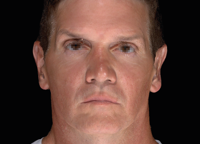 Emface_PIC_053-After-face-male-Charles-Boyd-MD-4TX_101_412x296px