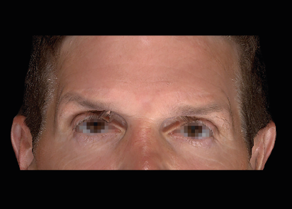 Emface_PIC_053-After-face-male-Charles-Boyd-MD-4TX_101_412x296px_1