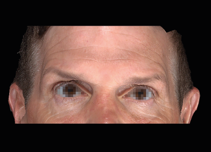 Emface_PIC_053-Before-face-male-Charles-Boyd-MD_101_412x296px_1