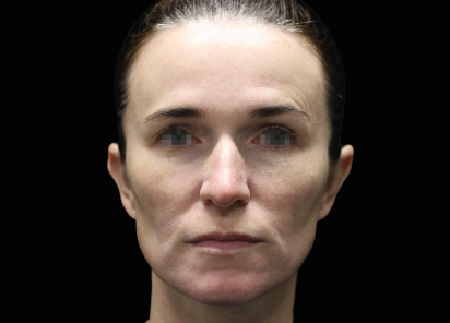 Emface_PIC_057-Before-face-female-Joel-L-Cohen-MD_101_412x296px