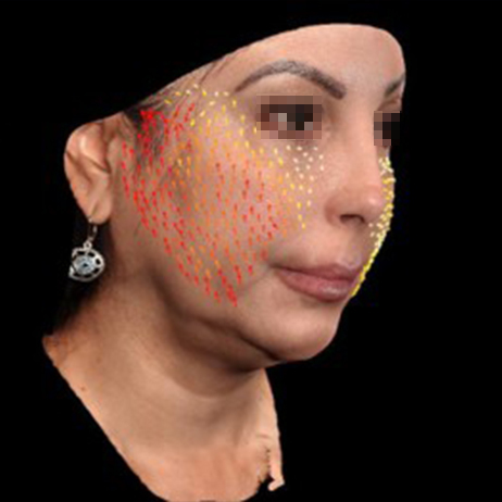 Emface_PIC_151-After-face-injectables-female-Bruce-Katz-MD-1M_462x462px_1725370580_original_v2