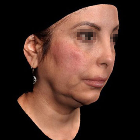 Emface_PIC_151-Before-face-injectables-female-Bruce-Katz-MD_462x462px_1725370581_original_v2