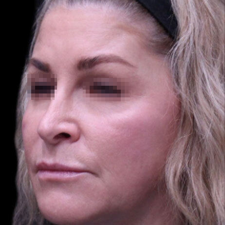 Emface_PIC_153-After-face-injectables-female-Suneel-Chilukuri-MD-3M_462x462px_1725370578_original_v2