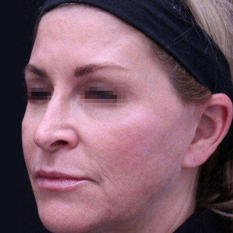 Emface_PIC_153-Before-face-injectables-female-Suneel-Chilukuri-MD_1725370579_original_v2