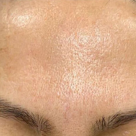 Emface_PIC_154-After-face-injectables-female-Panajot-Papa-MD_462x462px