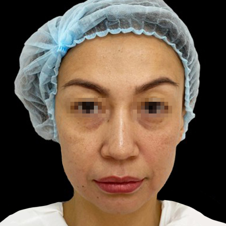 Emface_PIC_155-Before-face-injectables-female-Zimina-Yelena-MD_462x462px_1725602618_original_v2