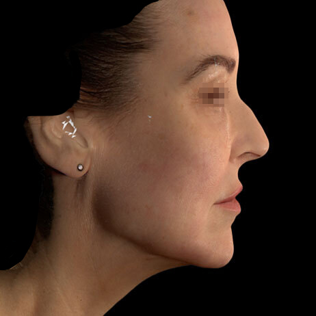 Emface_PIC_156-After-face-injectables-female-Lee-Walker-MD_462x462px_1725602673_original_v2