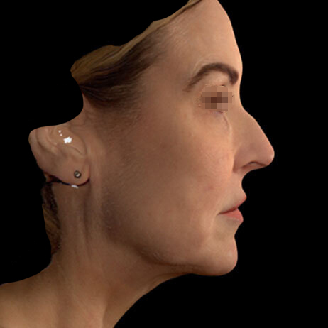 Emface_PIC_156-Before-face-injectables-female-Lee-Walker-MD_462x462px_1725602659_original_v2