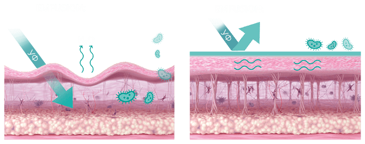 Аппарат EMFUSION как работает