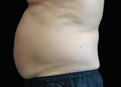 Emsculpt_neo_PIC_002-before-abdomen-male-David-Kent-MD__412x296px_1602587254_thumb