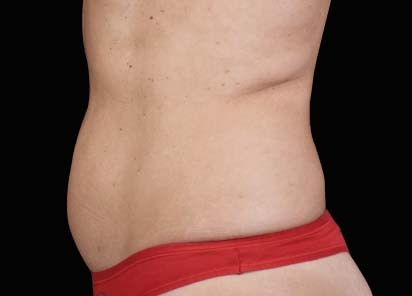 Emsculpt_neo_PIC_017-after-abdomen-female-David-Kent-MD-1M__412x296px_1647604434_original