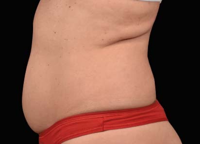 Emsculpt_neo_PIC_017-before-abdomen-female-David-Kent-MD__412x296px_1647604437_original