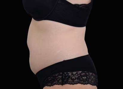 Emsculpt_neo_PIC_020-after-abdomen-female-David-Kent-MD-1M_412x296px_1647604432_original