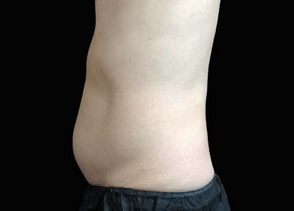 Emsculpt_neo_PIC_022-after-abdomen-male-David-Kent-MD-3M__412x296px_1602587287_original