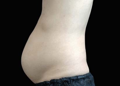 Emsculpt_neo_PIC_022-before-abdomen-male-David-Kent-MD__412x296px_1602587290_original