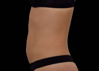 Emsculpt_neo_PIC_023-after-abdomen-female-Bruce-E-Katz-MD-1M__412x296px_1602587291_original