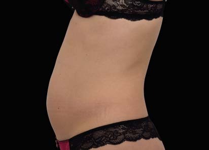 Emsculpt_neo_PIC_023-before-abdomen-female-Bruce-E-Katz-MD__412x296px_1602587294_original