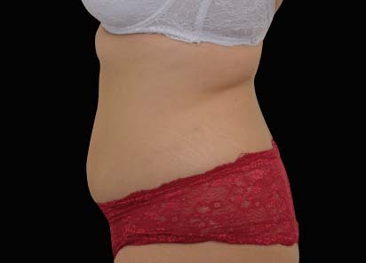 Emsculpt_neo_PIC_025-after-abdomen-female-BTL-Aesthetics-1M__412x296px_1602587302_original