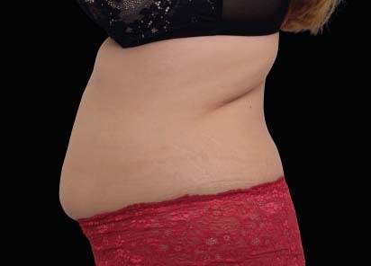 Emsculpt_neo_PIC_025-before-abdomen-female-BTL-Aesthetics__412x296px_1602587304_original