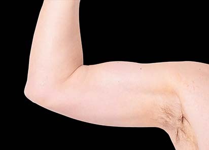 Emsculpt_neo_PIC_027-after-arms-male-Bruce-E-Katz-MD-3M_412x296px_1602658154_original_New