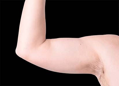 Emsculpt_neo_PIC_027-before-arms-male-Bruce-E-Katz-MD__412x296px_1602658157_original_New